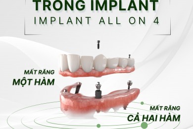Trồng Răng Implant All On 4 Cho Người Mất Răng Toàn Hàm